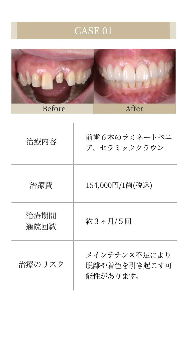 前歯６本のラミネートベニア、セラミッククラウン