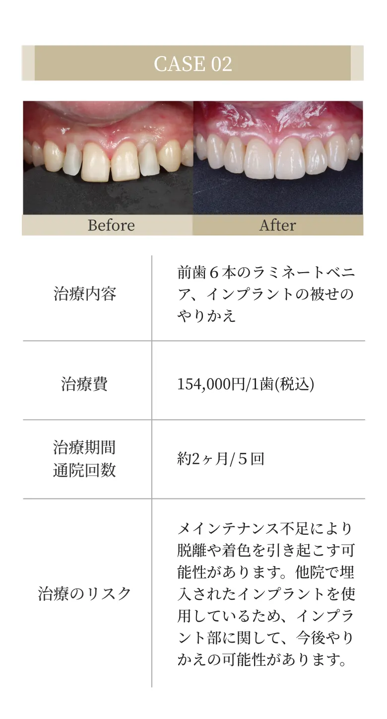 前歯６本のラミネートベニア、インプラントの被せのやりかえ