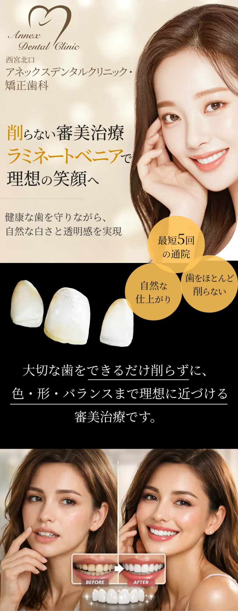 削らない審美 治療ラミネートベニアで理想の笑顔へ