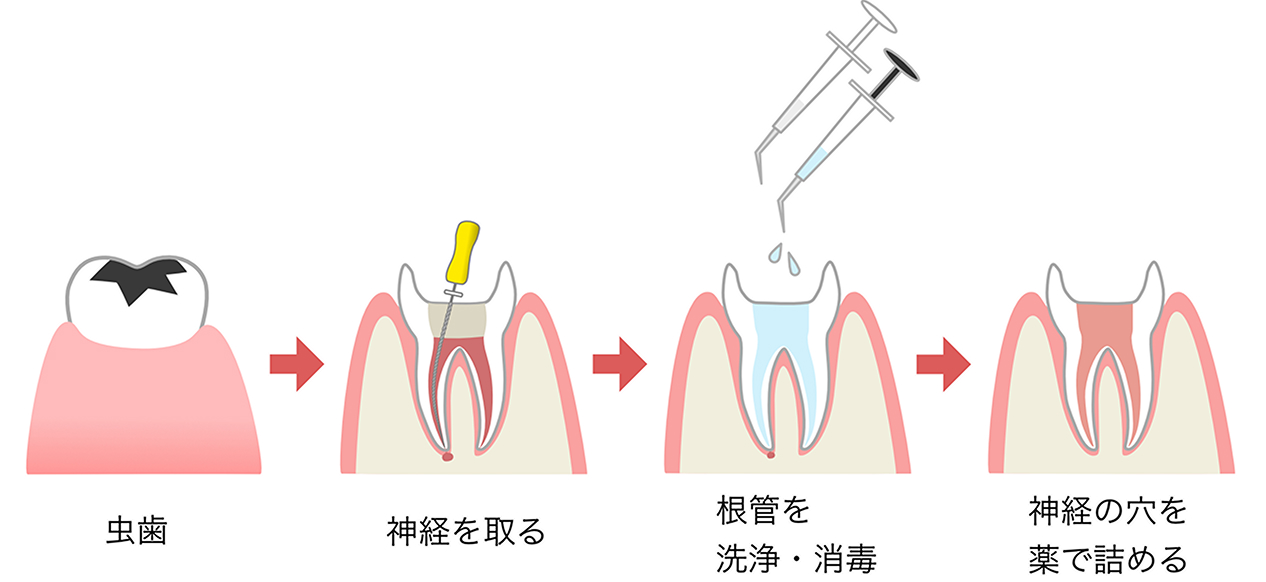 根管治療の流れ