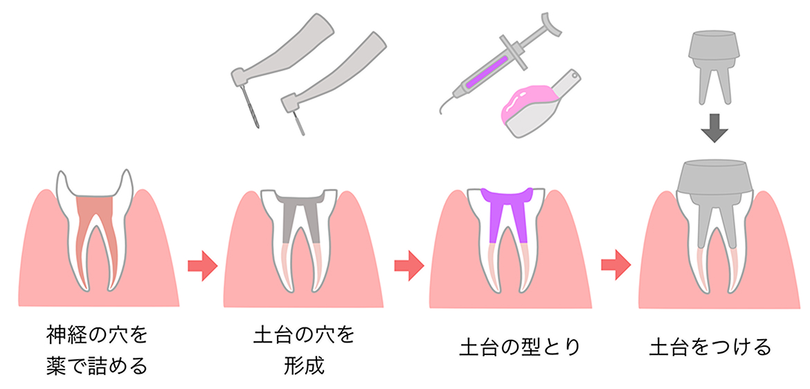 根管治療の流れ