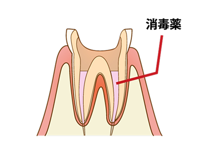 根管洗浄