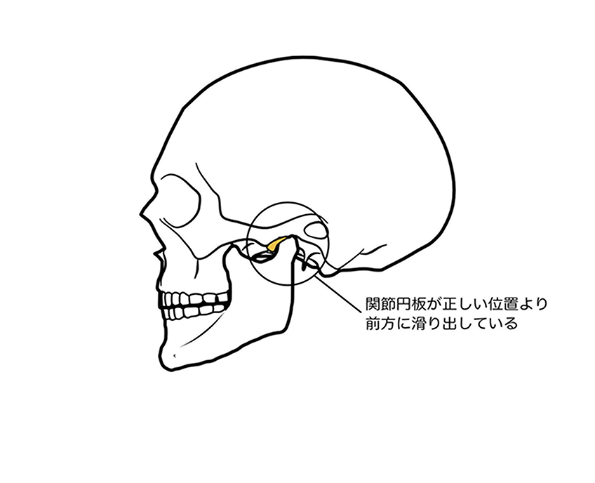 知覚過敏