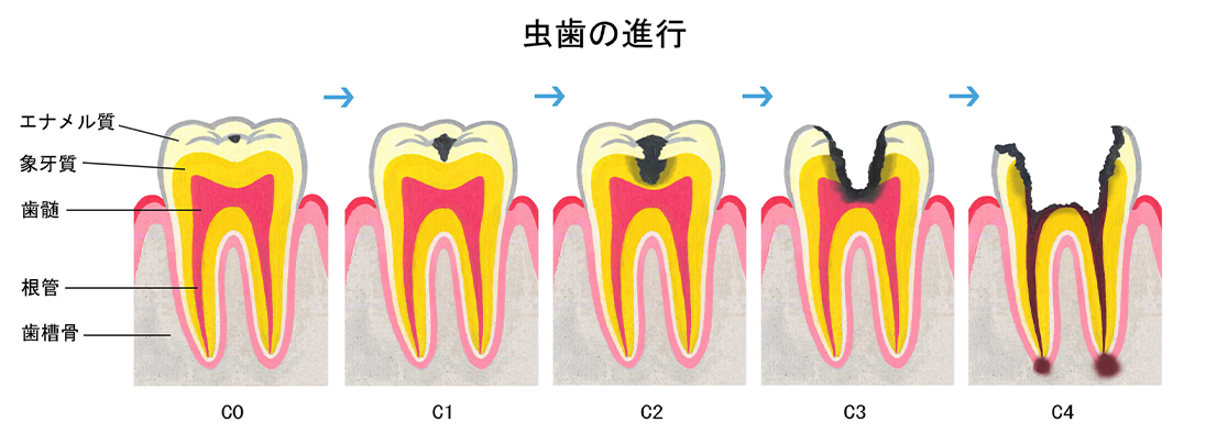 虫歯の進行の説明