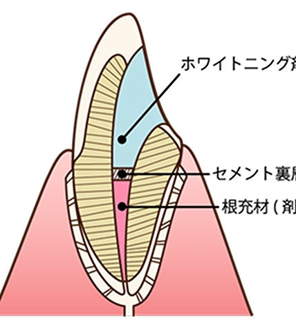 治療用入れ歯