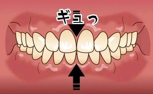 強く食いしばる、上下の歯をグッと押し付ける歯の画像