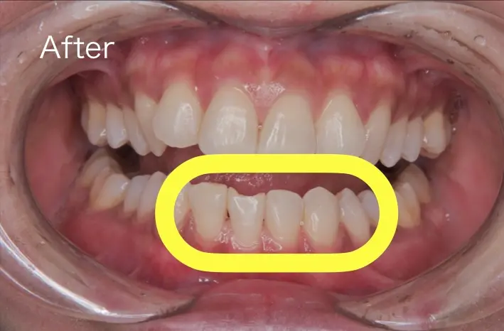 歯石を除去した後の前歯の写真