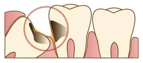 親知らずが原因で汚れが溜まっている歯の画像