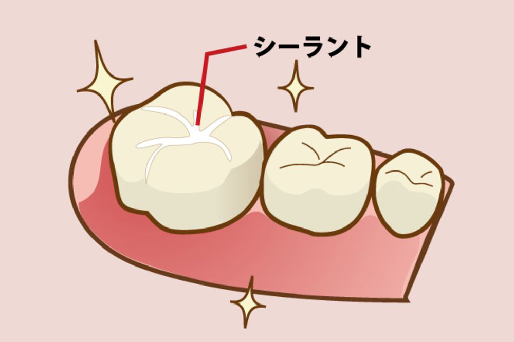 シーラント充填