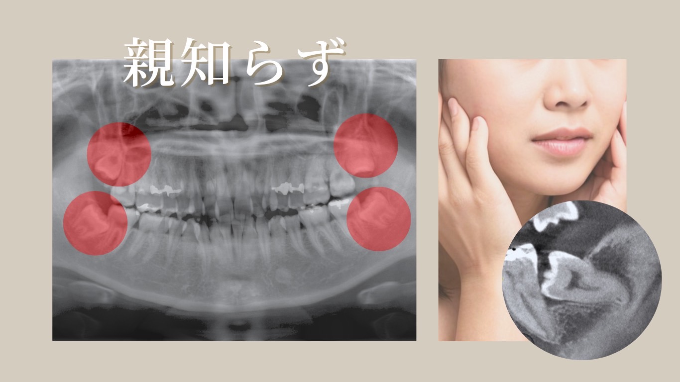 親知らず