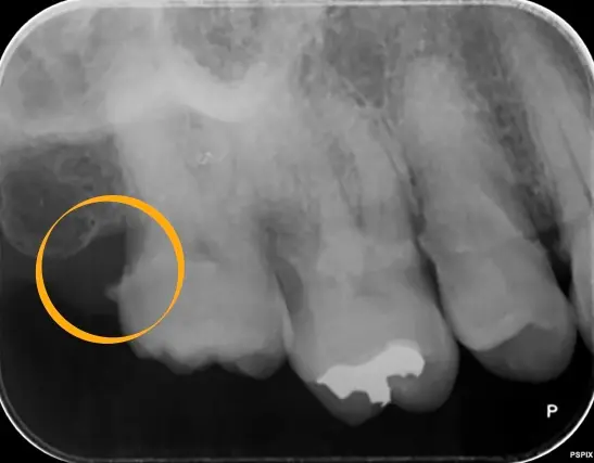 実際に縁下歯石がついているレントゲン写真