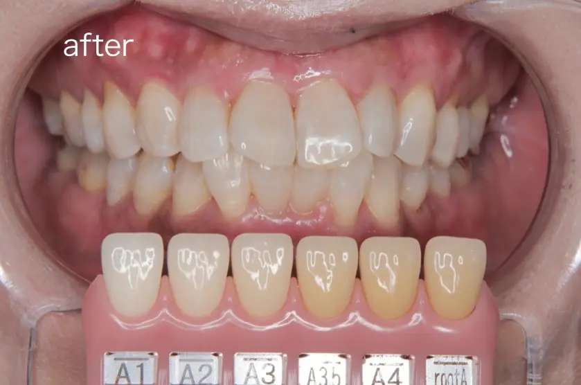 ホワイトニングをした後の写真
