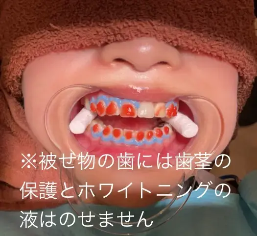 実際にホワイトニングをしている患者様の写真