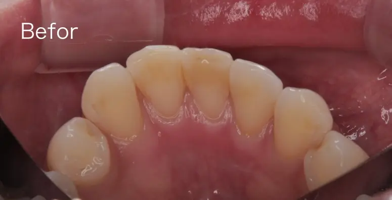 歯石を除去する前の写真