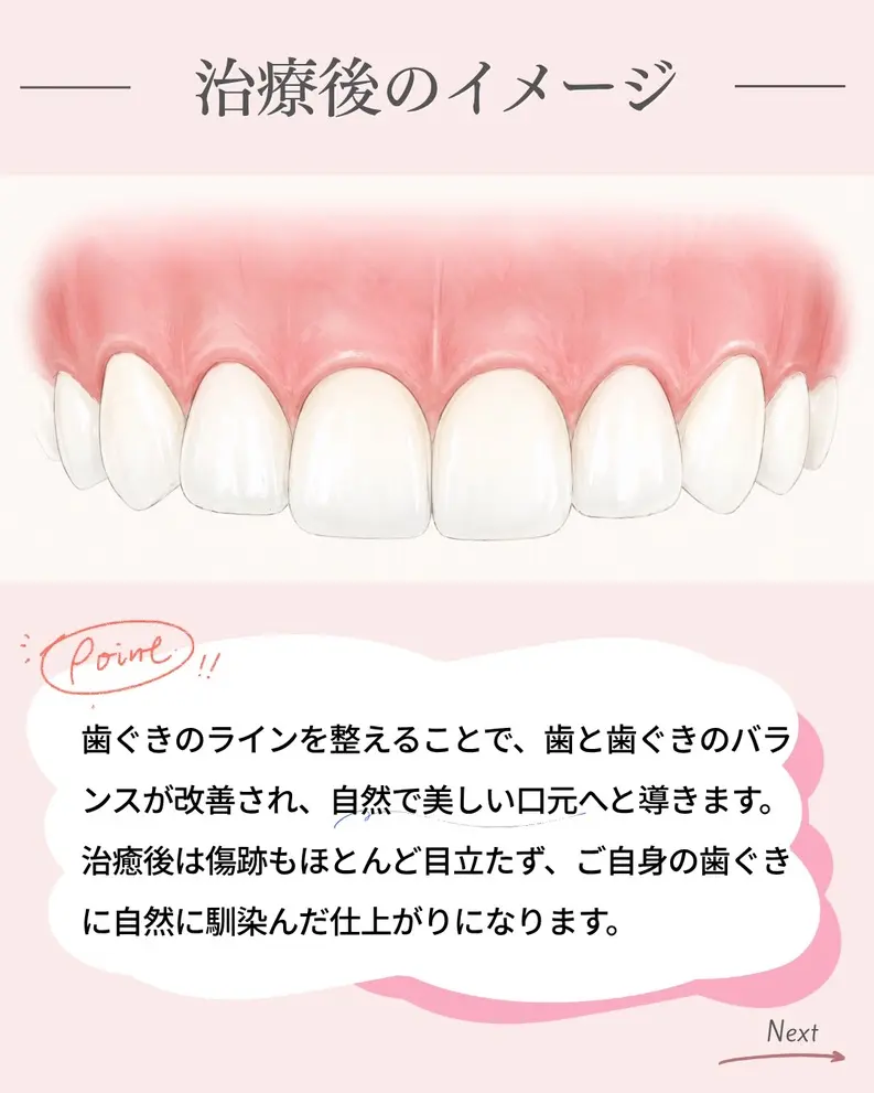ガミースマイル治療後の口元のイメージ。歯ぐきの見える量を調整し、自然で美しい笑顔へ導いた状態を表現している画像。