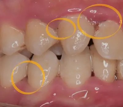 実際に縁下歯石がついている口腔内の写真