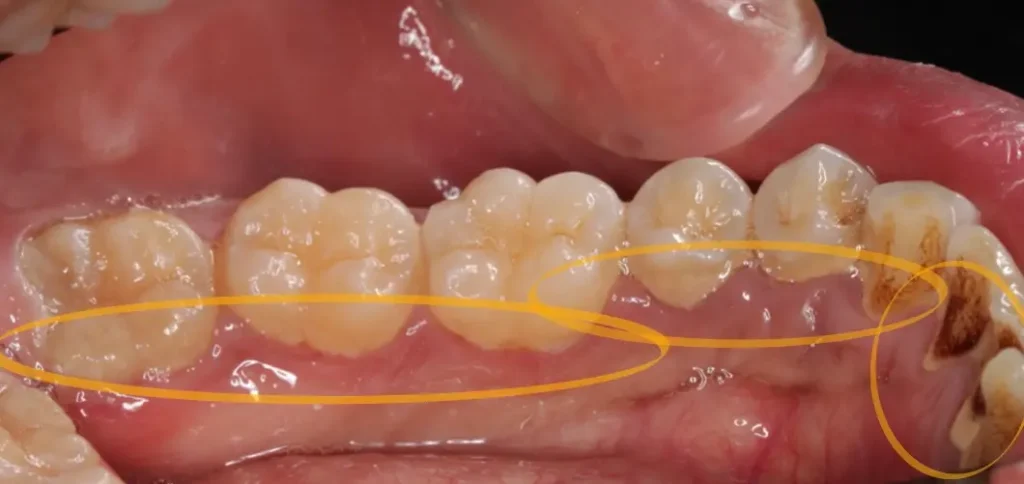 実際に縁上歯石がついている口腔内の写真