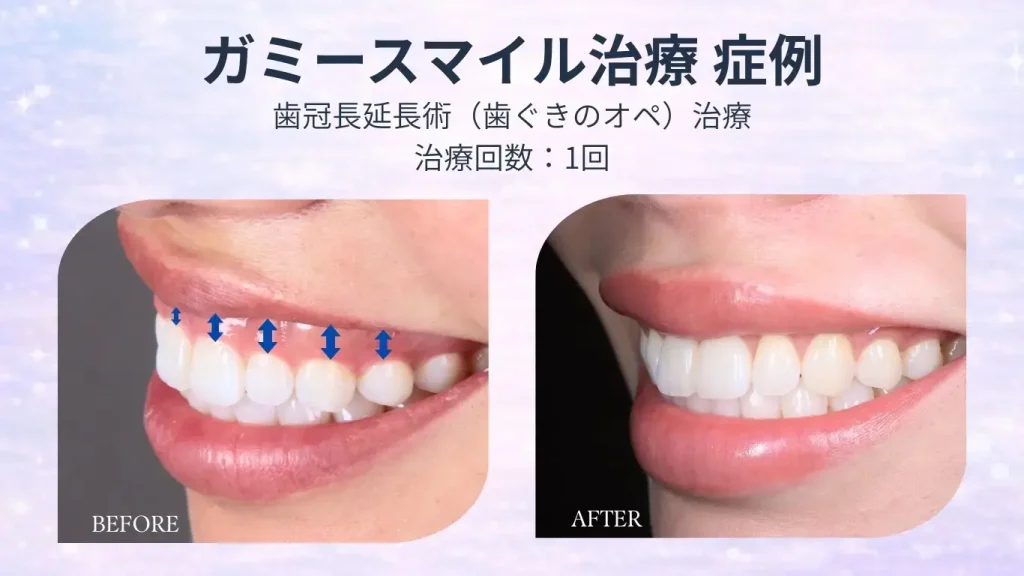 ガミースマイル治療の症例