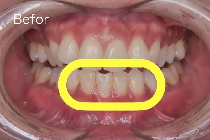 歯石を除去する前の前歯の写真