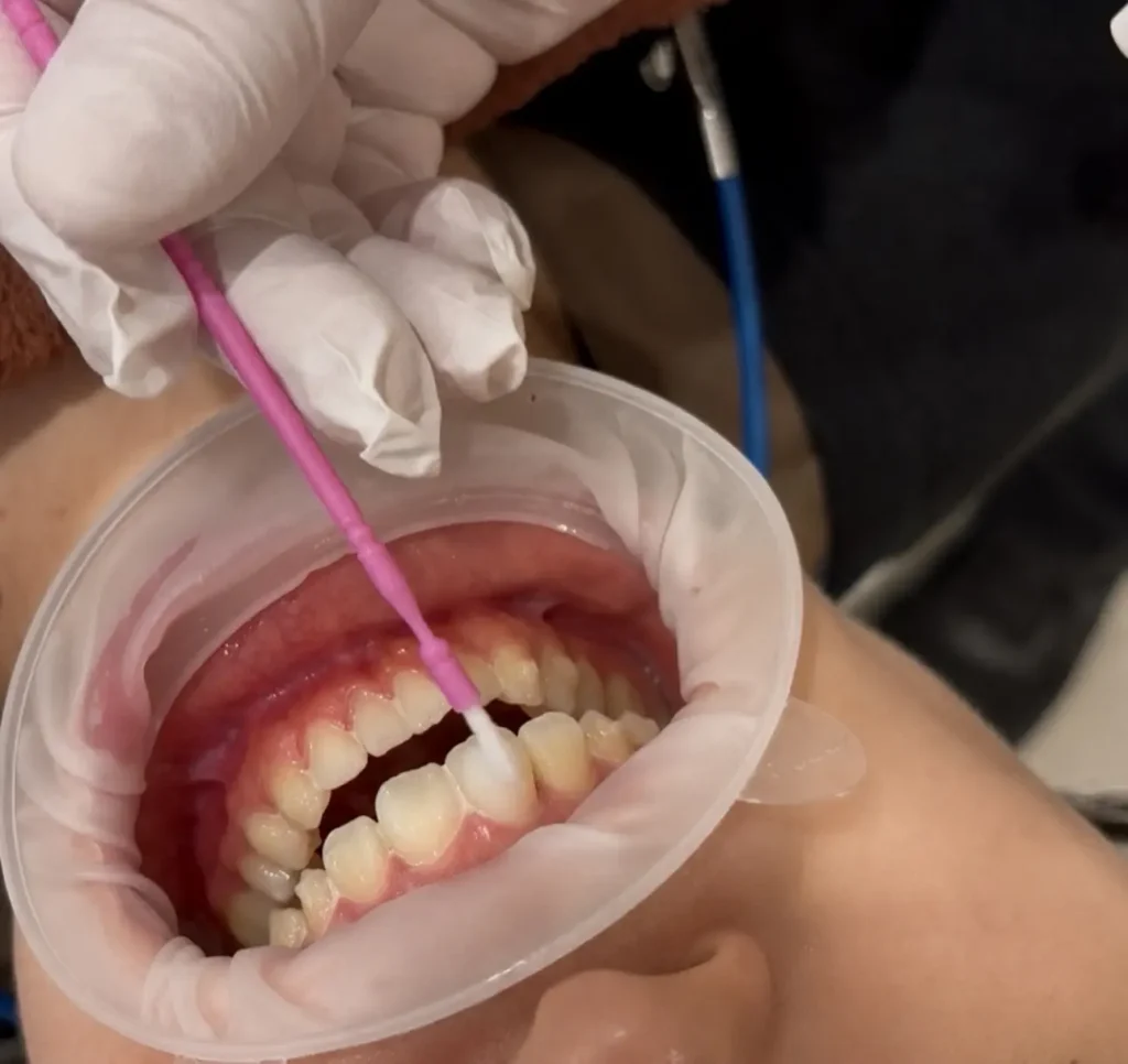 ホワイトニング剤を歯に塗布している写真