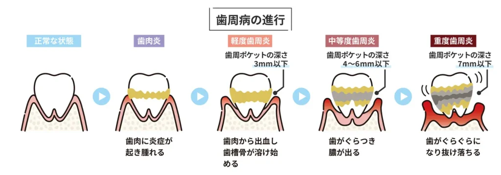 歯周病の進行段階を示したイラスト