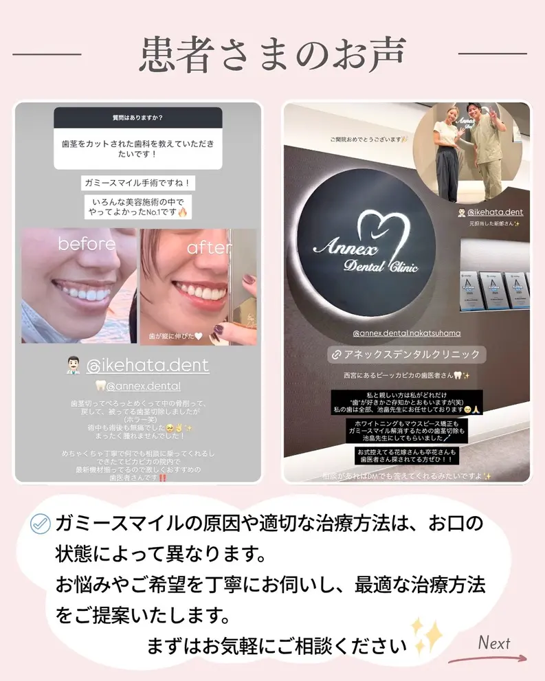 ガミースマイル治療を受けた患者様の口コミ紹介をしている画像。