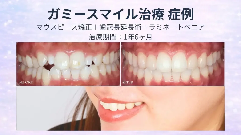 ガミースマイル治療の症例