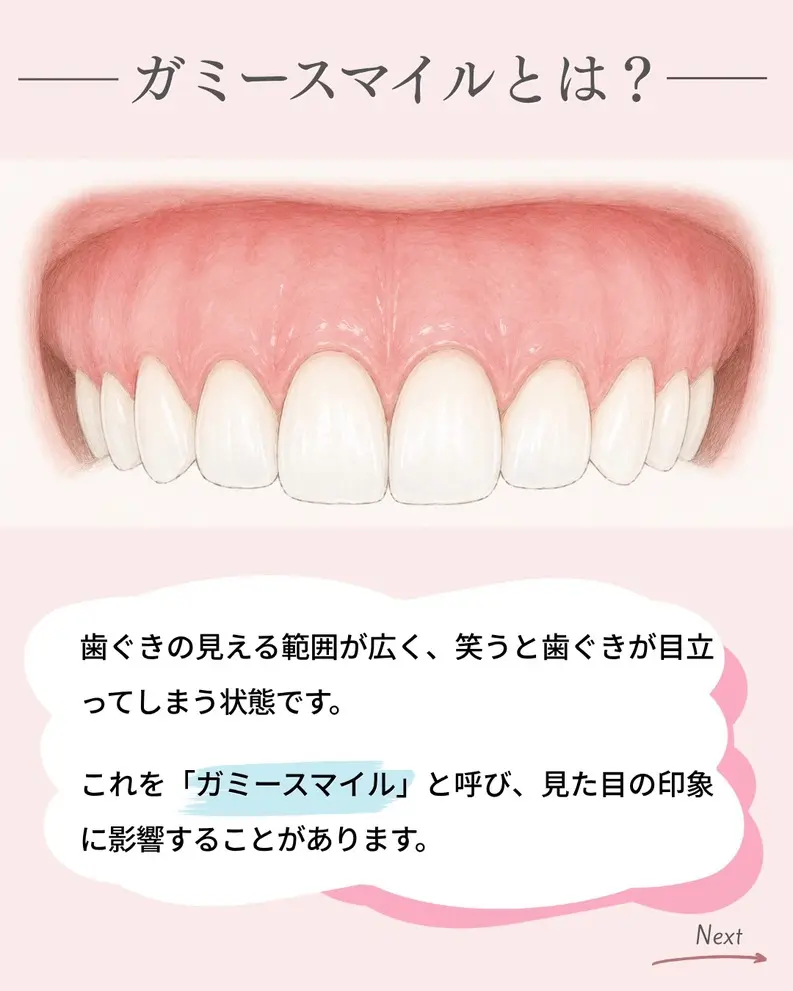 ガミースマイルの特徴を解説するイラスト。笑った際に歯ぐきが目立つ状態のついて説明している画像。