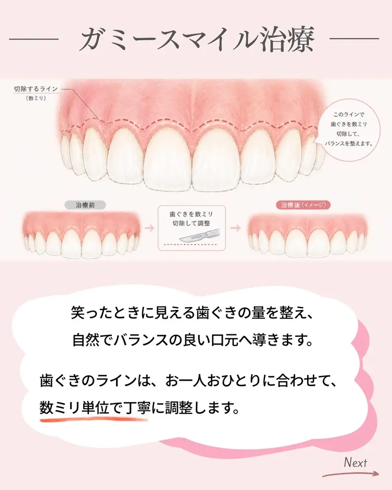 ガミースマイル治療のイメージ図。歯ぐきを数ミリ切除して歯ぐきの見える量を調整し、自然な口元へ導く治療の画像。
