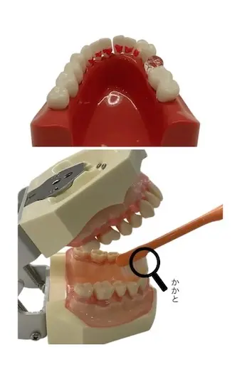 下の前歯の裏側（舌側）の磨き残しと歯ブラシの当て方の画像