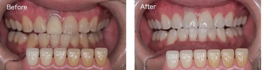 デュアルホワイトニングをした患者様のビフォーアフターの歯の写真