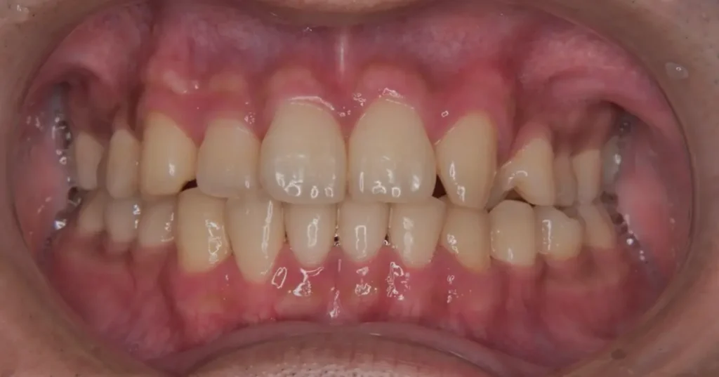 ②の患者さまの歯石除去した後の口腔内写真