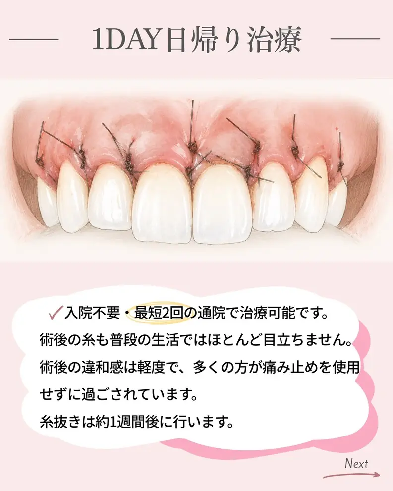 ガミースマイルの日帰り治療を解説するイラスト。歯ぐき形成後の縫合状態や治療期間の目安を紹介している画像。