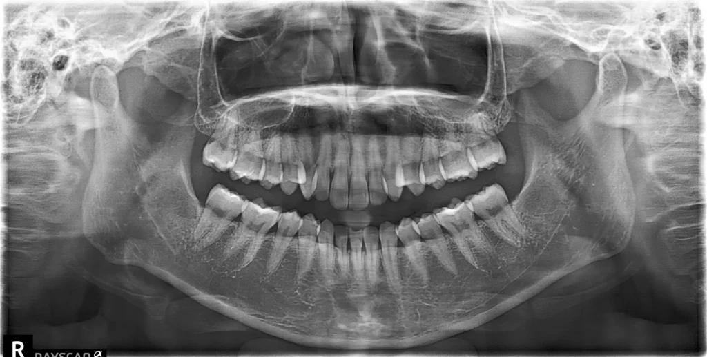 歯や顎の状態を確認するためのパノラマX線写真