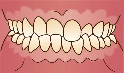上下の歯が重なり合っている不正咬合のイラスト