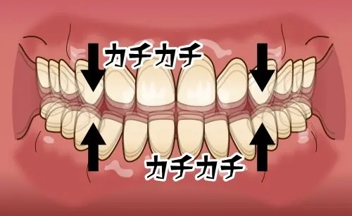 歯をカチカチと鳴らす歯の画像