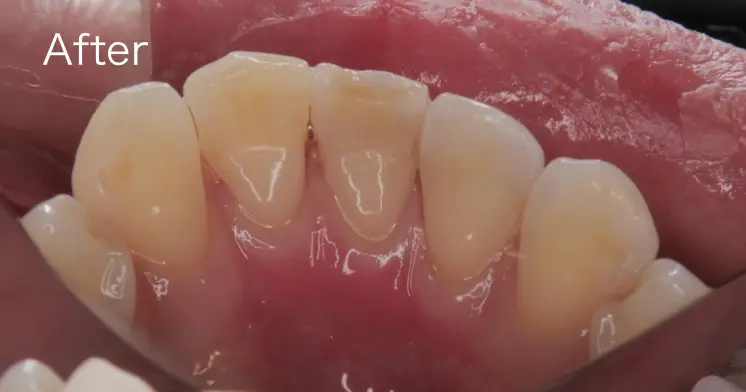 歯石を除去した後の写真
