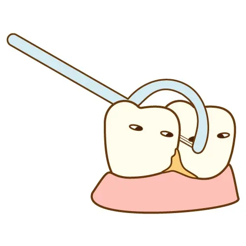歯間ブラシで歯と歯の間の汚れを取り除くイラスト