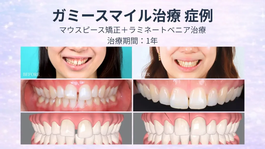 ガミースマイル治療の症例