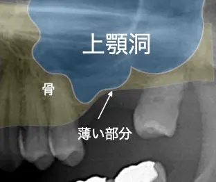 上顎の歯を失っている部分のレントゲン画像で上顎洞が大きく、骨が薄いことがわかる