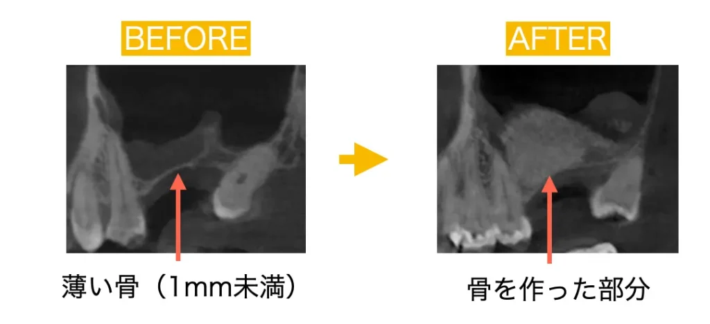 実際にサイナスリフトを行った症例の治療前、治療後のCT画像
