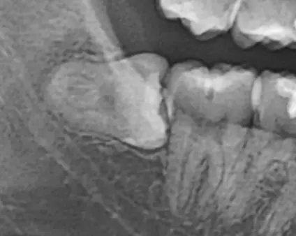 親知らずが横向きに生えているレントゲン画像