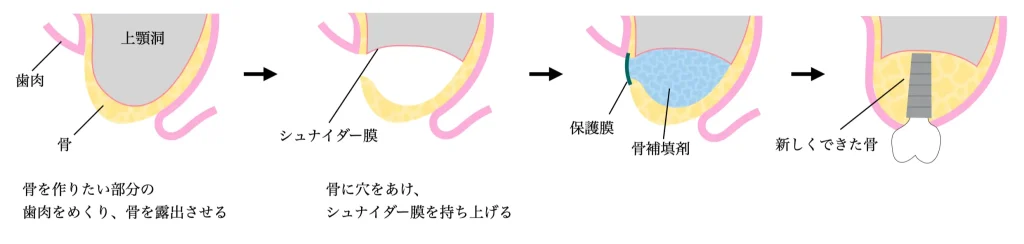サイナスリフトの手順のイラスト説明