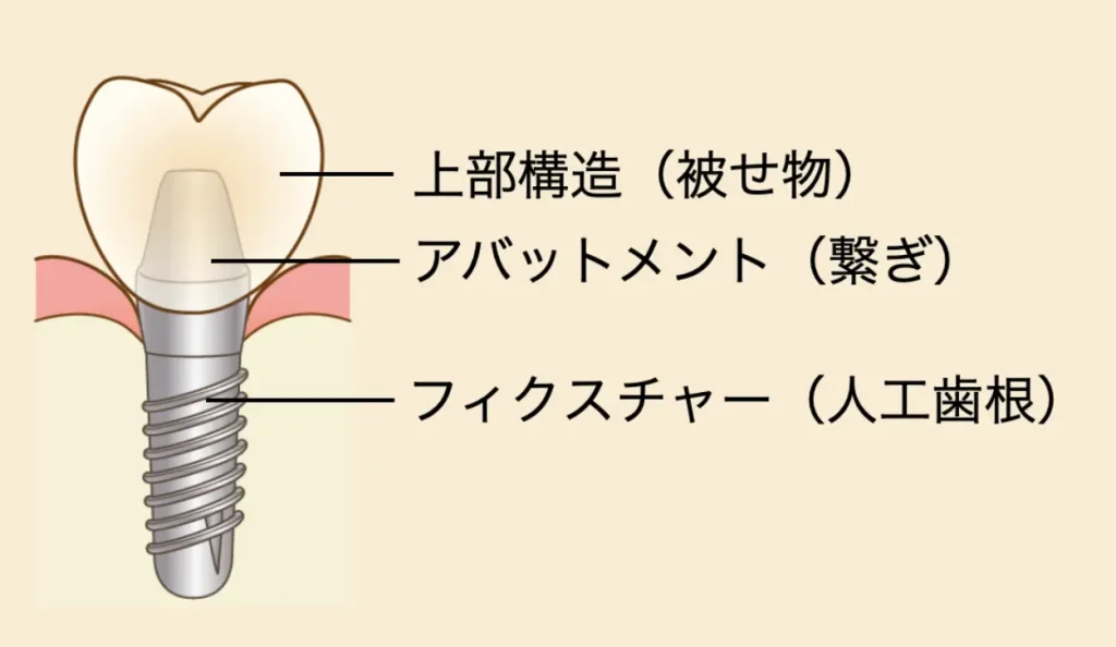 インプラントの構造を示している画像　上部構造とフィクスチャーがアバットメントで繋がれている