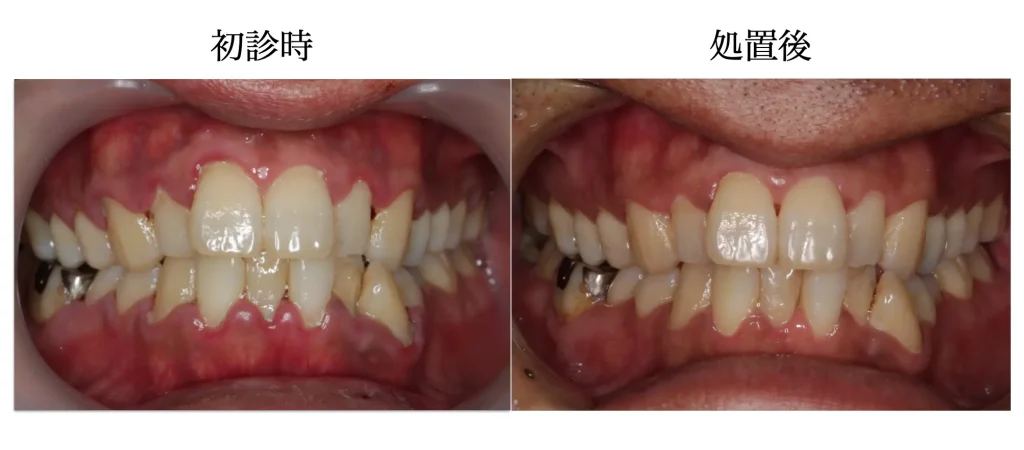 歯周病患者の初診時、歯肉が腫脹していることがわかる口腔内写真と、歯周病治療後に炎症が改善している様子がわかる口腔内写真の比較