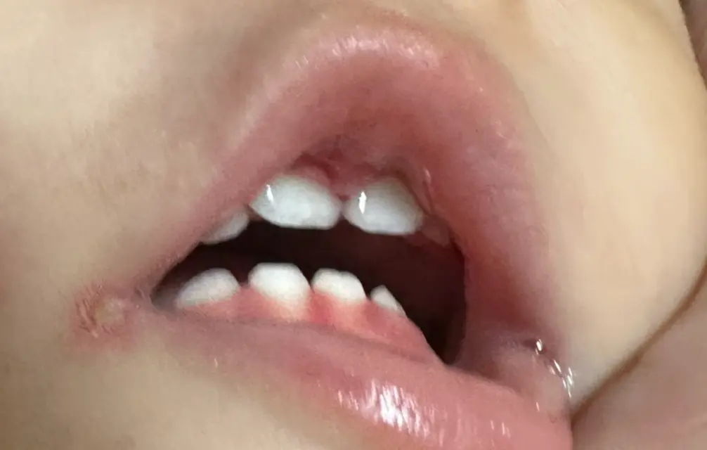 長女の口唇にヘルペス感染時に見られる特徴的な水疱ができている写真