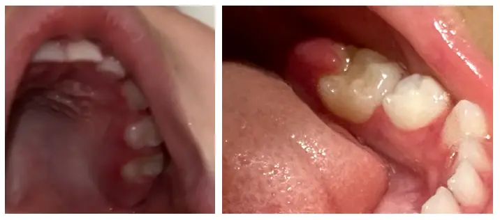 口腔内の歯肉が全体的に晴れて赤くなっている状態の写真