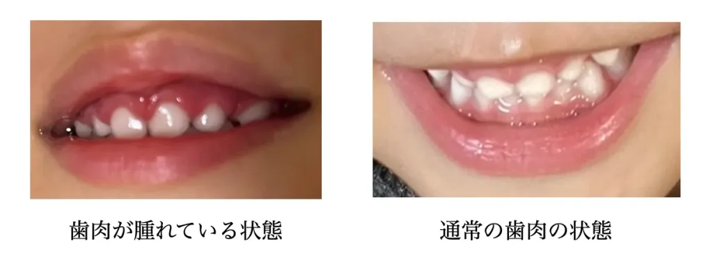 普段の歯茎と、ヘルペスで腫れてる歯茎の比較写真