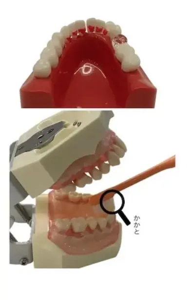 下の前歯の裏側（舌側）の磨き残しと歯ブラシの当て方の画像