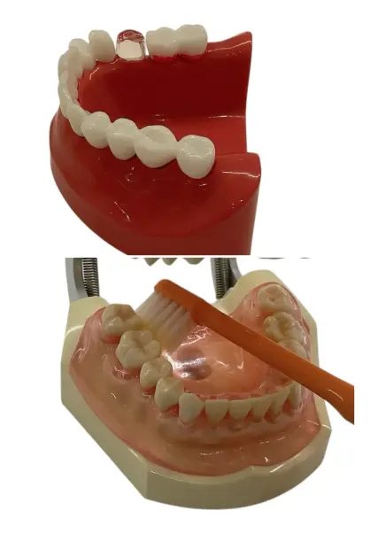 右の下の奥歯の裏側（舌側）の磨き残しと歯ブラシの当て方の画像